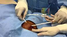 Short Term Catheters