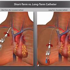 Short Term Catheters
